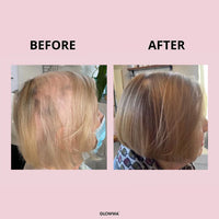 Before and after comparison of a person's hair, showing a shaved or treated scalp on the left and fuller, smoother hair on the right, on a light pink background with the text BEFORE, AFTER, and GLOWWA.