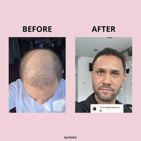 A before-and-after comparison graphic for a hair restoration or hair growth treatment. The left 'BEFORE' panel shows a top-down view of a person's bald scalp.